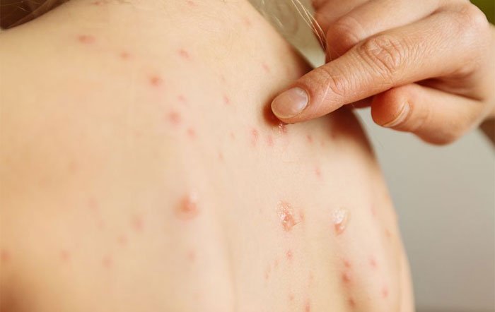 Salud alerta por brote de sarampión en la región pese a que Honduras está libre del virus 1 sarampion 1