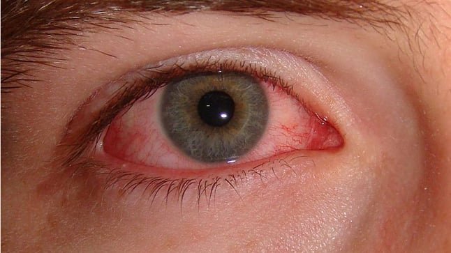 Clima inestable aumenta riesgos de problemas oculares, advierte especialista 1 ojo rojo