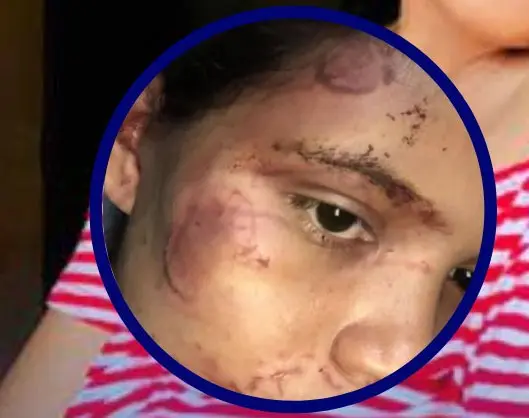 Hombre buscado por atacar a mordidas a su pareja en Olancho 4 MORDIDAS.jpg