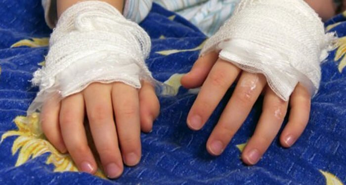 Quemaduras en menores siguen en aumento y ya superan los 450 casos este año 1 menor quemado 700x375 1